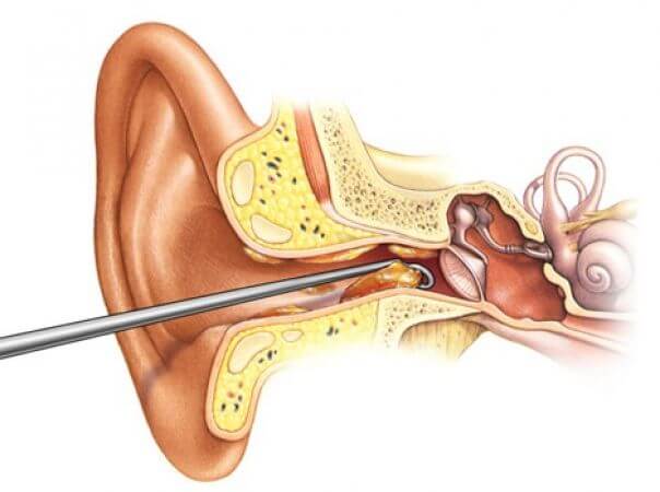 What is Ear Wax and How is Earwax Buildup Removed?