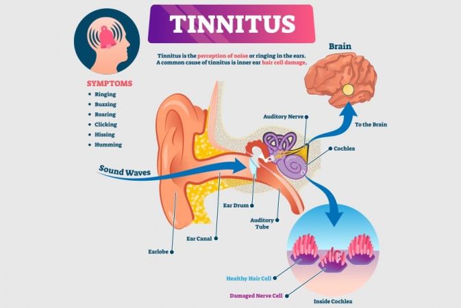 Ear on sale wax tinnitus